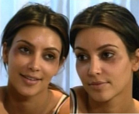 Kim Kardashian Gets Black Eyes from Botox | kim kardashian